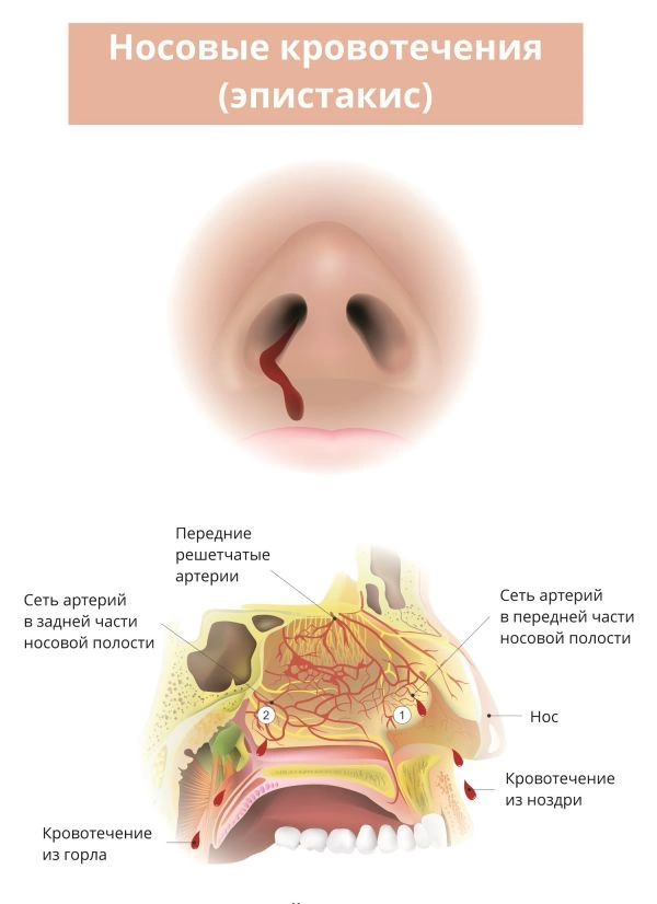 Причины носовых кровотечений у взрослых — узнай, что заставляет течь кровь из носа и как можно остановить этот процесс