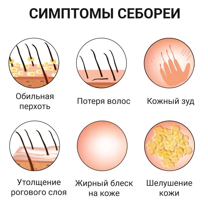 Себорея кожи головы: причины и симптомы. Подробное руководство