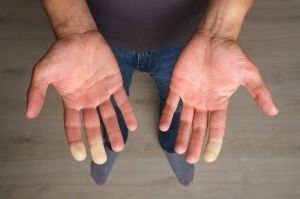 Врач-ревматолог в СПб: запись на прием и консультацию, цены | КДЦ НМИЦ им. В.А. Алмазова Облитерирующий тромбангиит