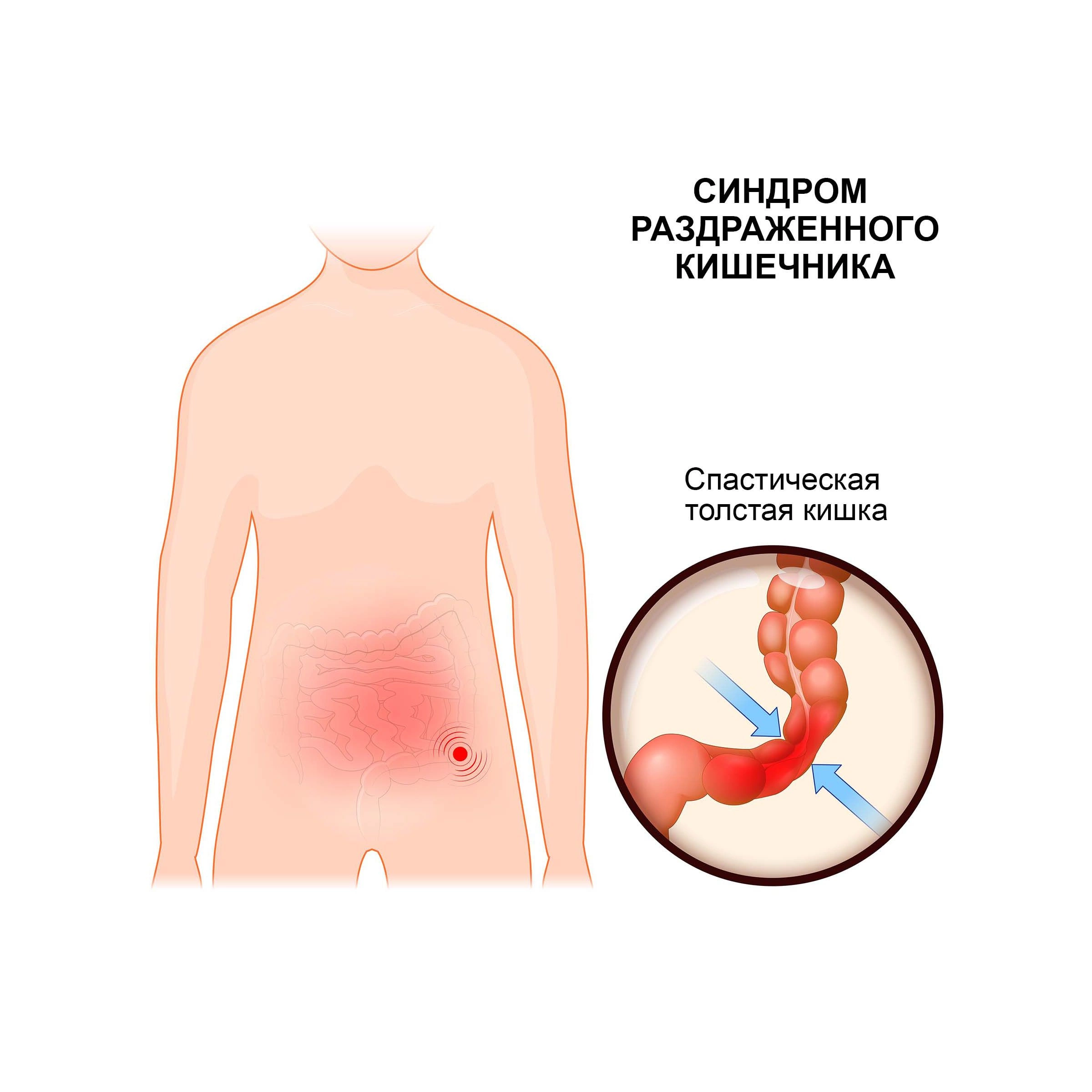 Синдром раздраженного кишечника: симптомы, причины, признаки,  классификация, как снять СРК